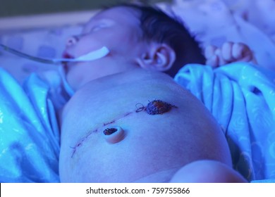Newborn baby with colostoma near postoperative surgical suture on anterior abdominal wall, orogastic tube and hyperbilirubinemia under blue UV light for phototheraphy in neonatal intensive care unit