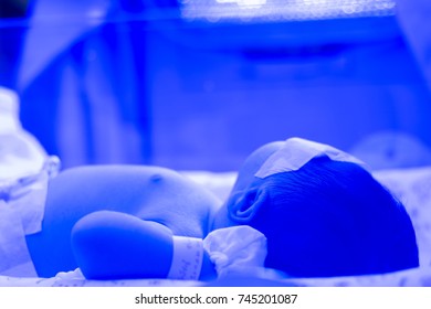 Newborn Baby With Hyperbilirubinemia / Neonatal Jaundice Under Blue UV Light For Phototheraphy On Infant Warmer In Neonatal Intensive Care Unit