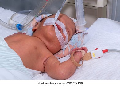 Newborn Baby With Hyperbilirubinemia On Breathing Machine Or Ventilator With Pulse Oximeter Sensor In Neonatal Intensive Care Unit At Children's Hospital