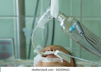 Newborn Baby On Breathing Machine (mechanical Ventilator) With Orogastric Tube In Neonatal Intensive Care Unit