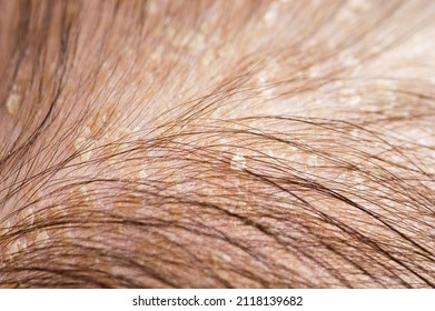 Newborn Baby With Psoriasis Or Dandruff In The Hair