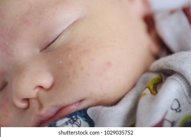 A Newborn Baby With A Baby Rash In Soft Focus