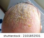 Newborn baby with symptoms of cradle cap (dermatitis seborrhoicum neonatorum) on the scalp.