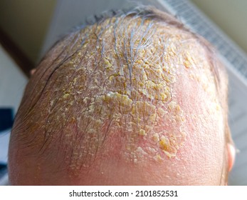 Newborn baby with symptoms of cradle cap (dermatitis seborrhoicum neonatorum) on the scalp. - Shutterstock ID 2101852531