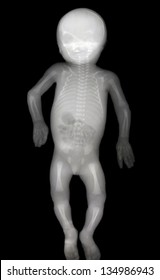  Newborn baby, X-ray