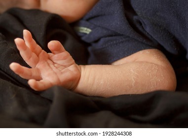 Newborn Baby's Hand, Flaky Skin, Allergies And Dermatitis