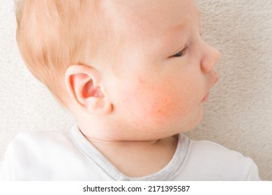 Newborn Boy Cheek With Red Rash. Allergy From Milk Formula Or Mother Milk. Baby Skin Problem. Closeup. Top Down View.