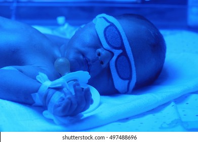 Newborn Child Baby Having A Treatment For Jaundice Under Ultraviolet Light In Incubator. A Neonatal Intensive Care Unit (NICU), Intensive Care Nursery (ICN) For Premature Newborn Infants. 