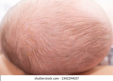 Newborn Head With Cradle Cap Or Infantile Seborrheic Dermatitis. Newborn Head With Seborrhea.
