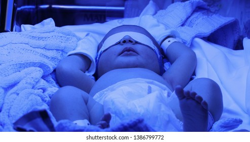 Newborn Under Jaundice Phototherapy. After Birth
