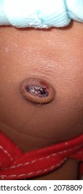 Newborn's Belly Button Bleeding, A Common Condition In Cord Healing  Process