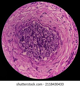 Nipple ulcer biopsy: Paget's disease of the nipple, microscopic image show skin, It reveals features of Paget's disease of nipple, focus 40x view.