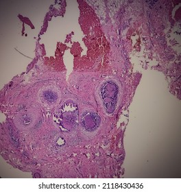 Nipple ulcer biopsy: Paget's disease of the nipple, microscopic image show skin, It reveals features of Paget's disease of nipple, focus 40x view.