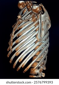 No Abnormality in thoracic bones. 