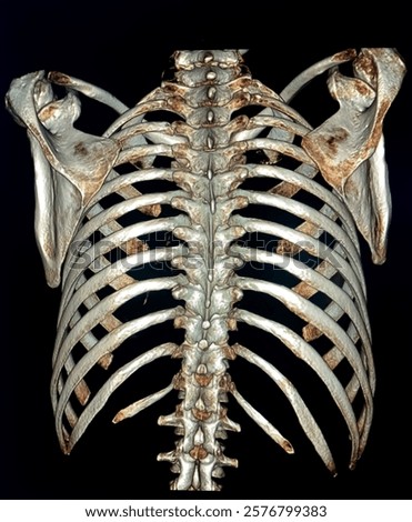 No Abnormality in thoracic bones. 