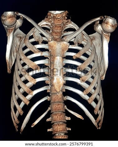 No Abnormality in thoracic bones. 