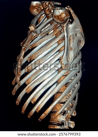 No Abnormality in thoracic bones. 