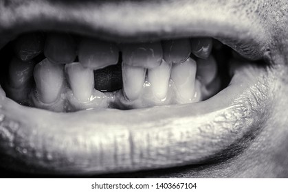 No Teeth. Smile Men With A Lost Front Tooth, Toothache. Yellow Teeth. Man Without One Front Tooth. Bad Dental Health, No Teeth, No Fluoride, Tooth Erosion. Black And White