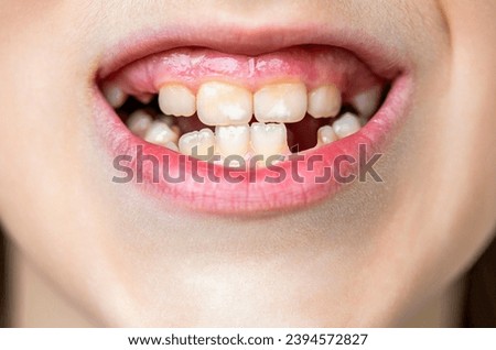 No teeth. Yellow teeth. Bad dental health, no teeth, no fluoride, tooth erosion. Portrait boy with bad teeths. Child bad teeth. Boy kid lost front tooth, toothache. Child without one front tooth.