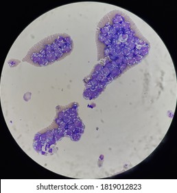 Non Hodgkin Lymphoma Cell In Body Fluid.