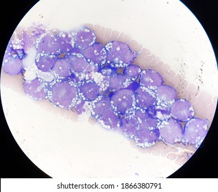 Non Hodgkin Lymphoma Cell In Body Fluid.