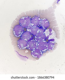 Non Hodgkin Lymphoma Cell In Body Fluid.