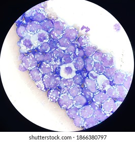 Non Hodgkin Lymphoma Cell In Body Fluid.