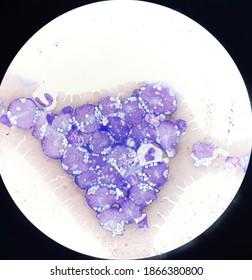 Non Hodgkin Lymphoma Cell In Body Fluid.