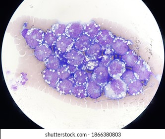 Non Hodgkin Lymphoma Cell In Body Fluid.