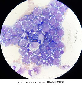 Non Hodgkin Lymphoma Cell In Body Fluid.