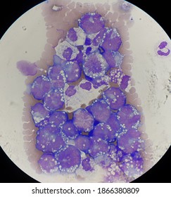 Non Hodgkin Lymphoma Cell In Body Fluid.