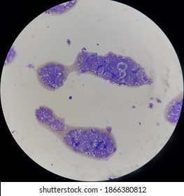 Non Hodgkin Lymphoma Cell In Body Fluid.