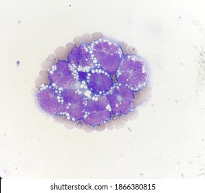 Non Hodgkin Lymphoma Cell In Body Fluid.