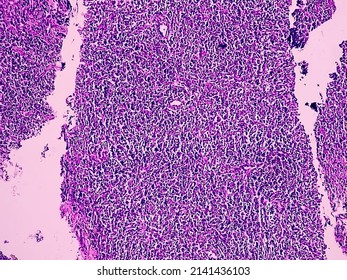 Non Hodgkin Lymphoma Histology Testing Image Analyzed By Microscope At Histopathology Laboratory.