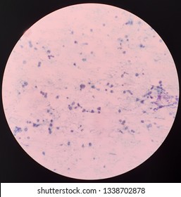 Non - Hodgkin’s Lymphoma