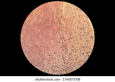 Non Small Cell Pulmonary Lung Carcinoma