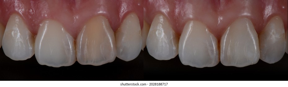Non vital teeth bleaching or internal bleaching, before and after shot. Individual teeth whitening on one central incisor. - Shutterstock ID 2028188717