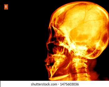 Schedel Ap Radiograph Skull Head Neck: Foto De Stock (editar Ahora ...