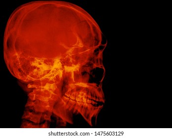 X Ray Head Schedel Lat Hot Stock Photo 1457517689 | Shutterstock