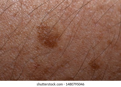 Noncancerous Mole On Caucasian Skin Stock Photo (Edit Now) 1480795046