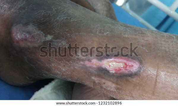 Nonhealing Foot Venous Ulcer Complication Probably Stock Photo (Edit