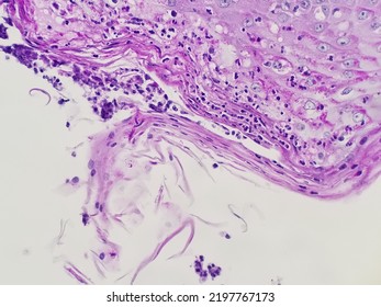 Non-septate Rhizopus Hyphae In Tissue Biopsy Sample