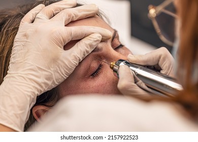 Procédures cosmétiques non chirurgicales pour les yeux par technique de fibroblaste plasmatique