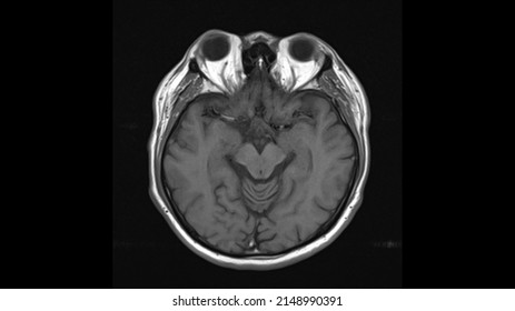 Normal Brain Anatomy Axial T Weighted Mri Stock Photo Shutterstock