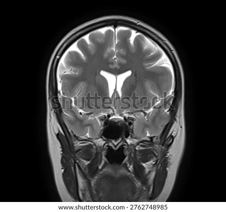 Normal brain MRI, coronal T2-weighted image showing cerebral hemispheres, cortex, lateral ventricles, basal ganglia, thalami, temporal lobes and sphenoid sinus.