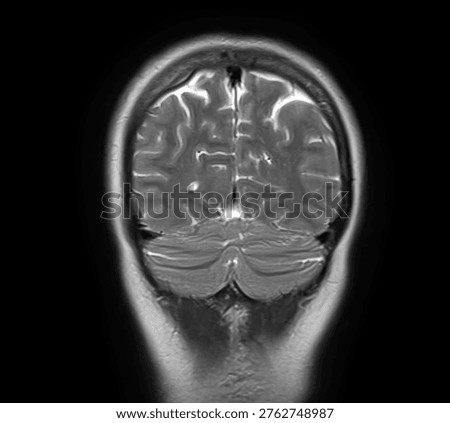 Normal brain MRI, coronal T2-weighted image showing cerebral hemispheres, cerebral cortex, cerebellum, cerebellar hemispheres, vermis and posterior fossa.