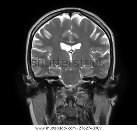 Normal brain MRI, coronal T2-weighted image showing cerebral hemispheres, cortex, lateral ventricles, thalami, mesial temporal lobes, hippocampi and brainstem.