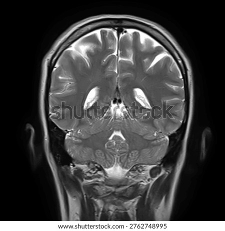 Normal brain MRI, coronal T2-weighted image showing cerebral hemispheres, lateral ventricles, cerebellum, cerebellar hemispheres, vermis and brainstem.