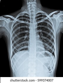 Normal Chest X Ray.