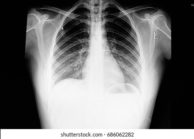 Normal Chest X Ray Film Of A  Patient Shows Normal Heart And Lungs Shadows